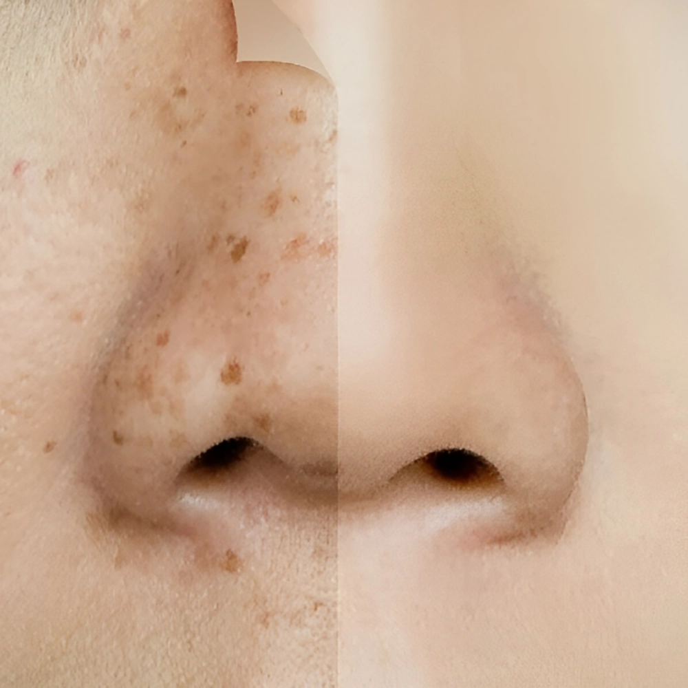 از بین بردن لک های پوستی صورت