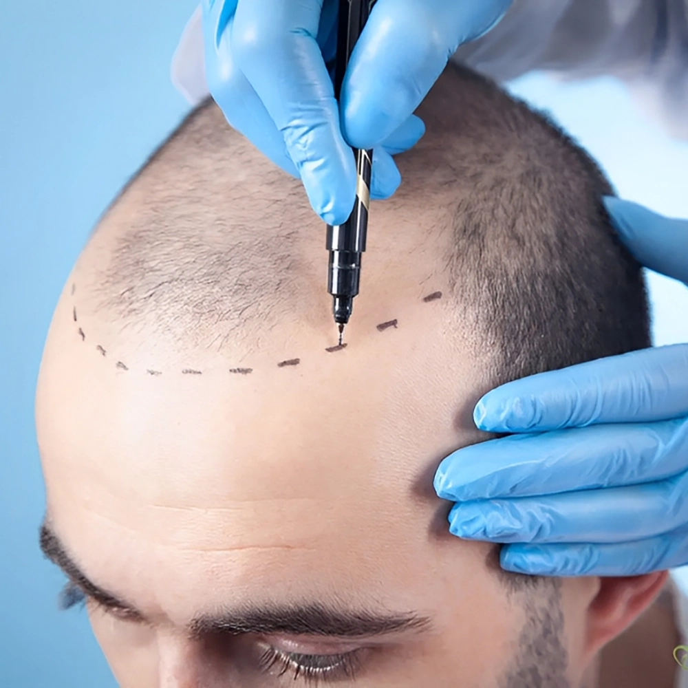 قویترین دارو برای رشد مو