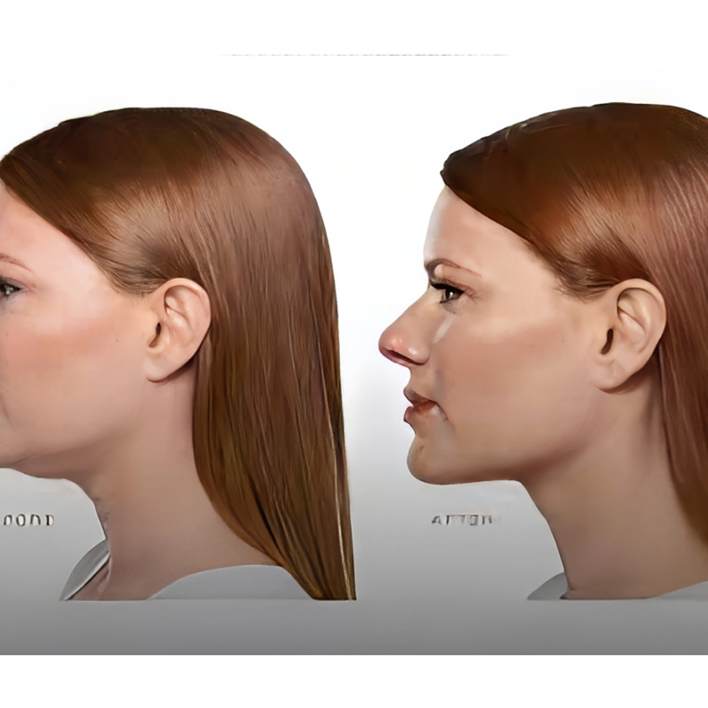 لاغری موضعی با مزوتراپی