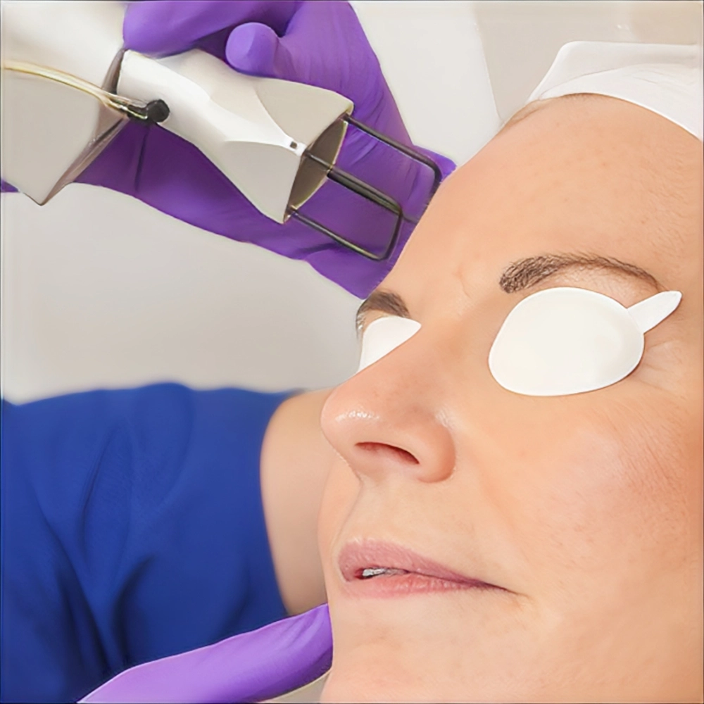 لیزر فرکشنال چیست