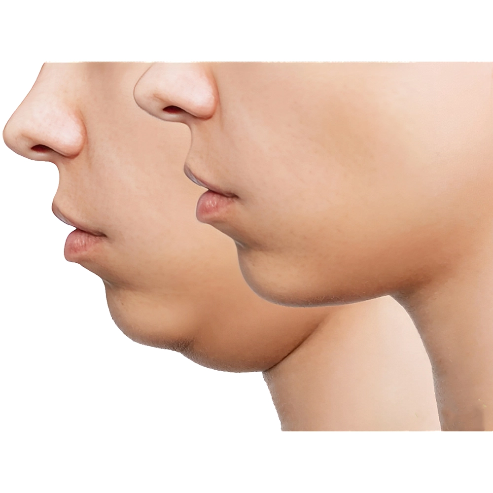 مزوتراپی غبغب چیست