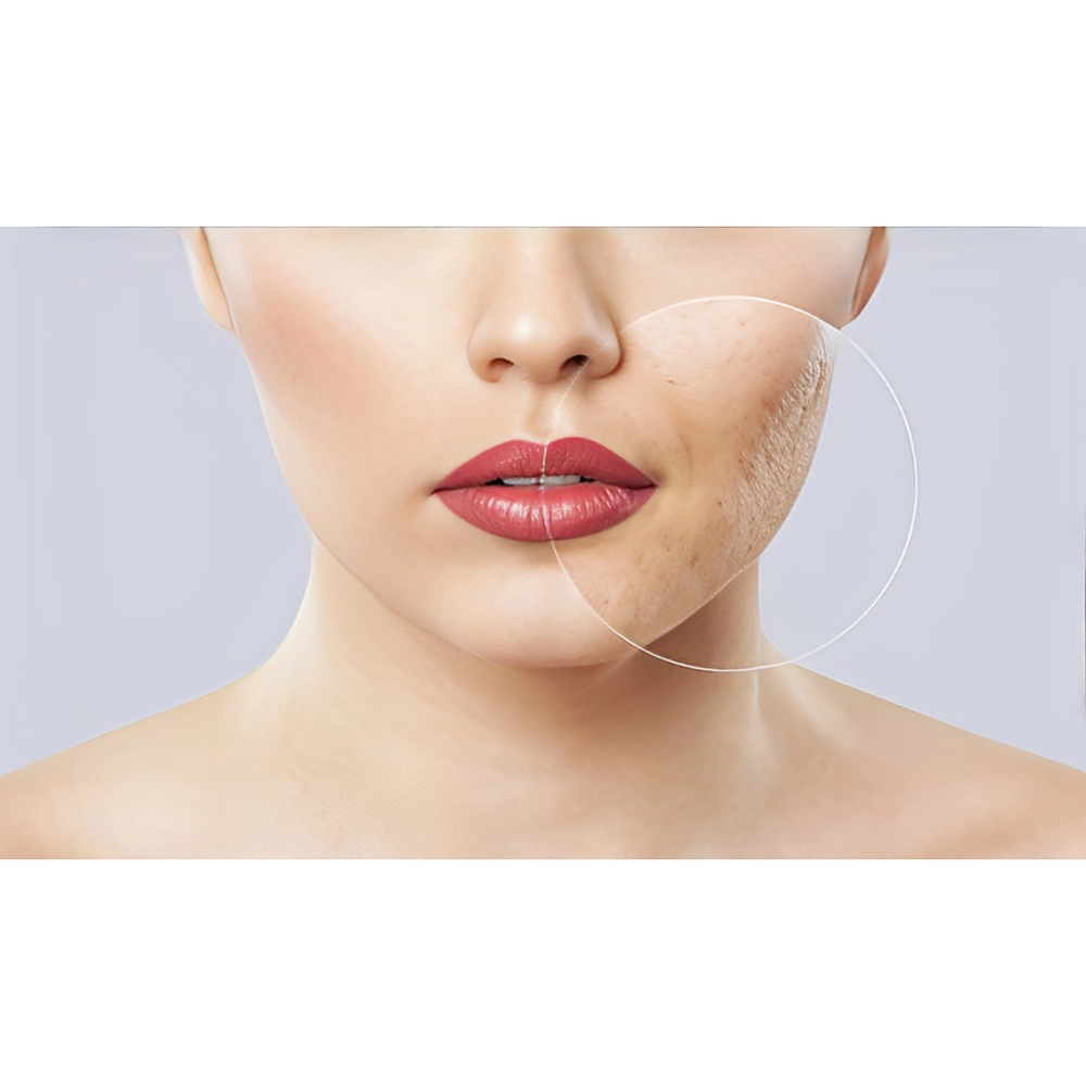 فرق لیزر فرکشنال با ار اف