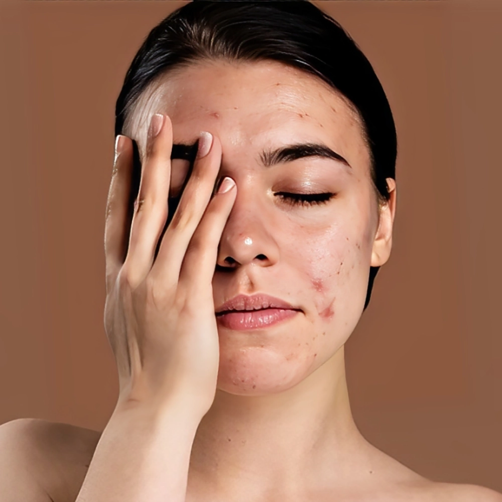 انواع آکنه و جوش صورت