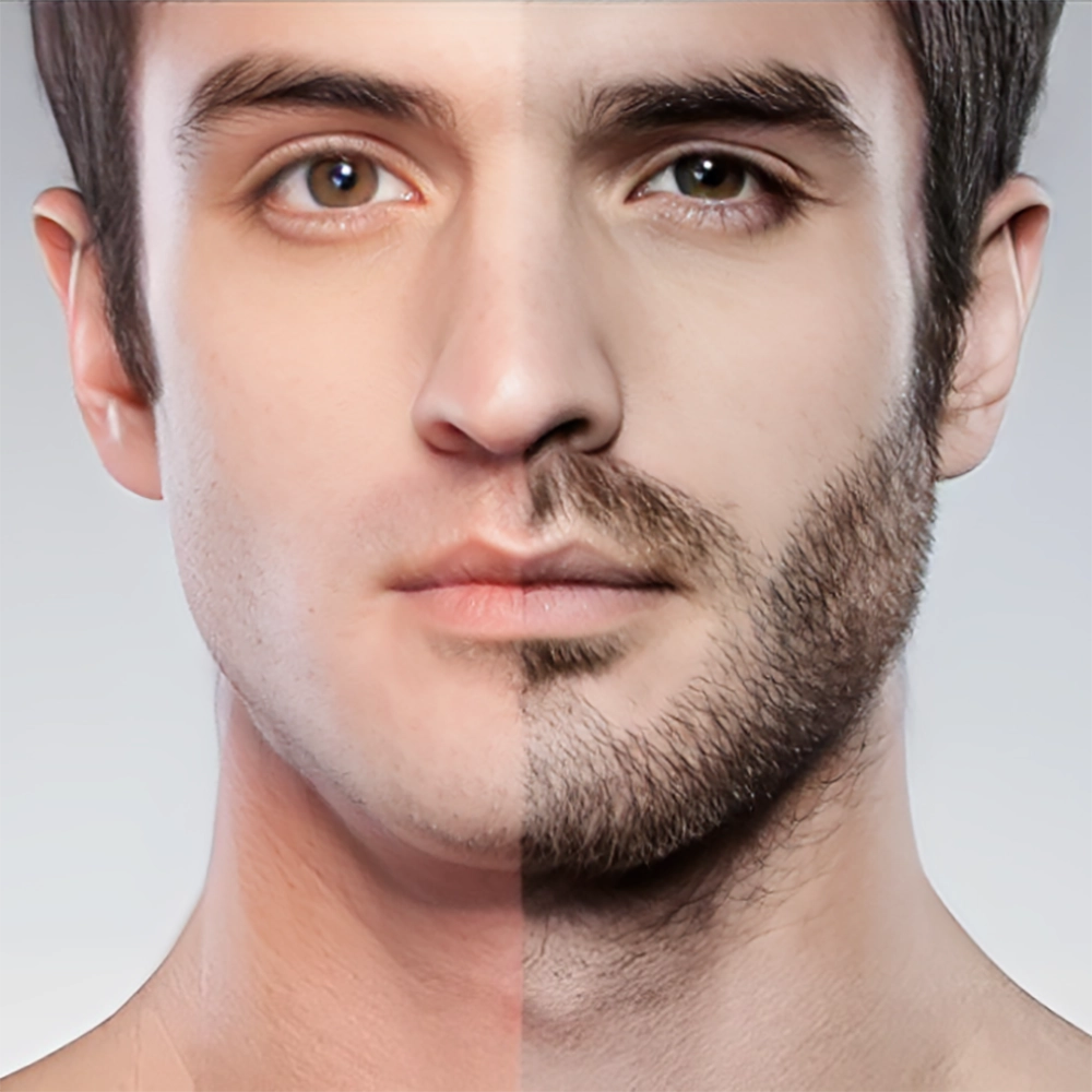 عوارض مزوتراپی ریش