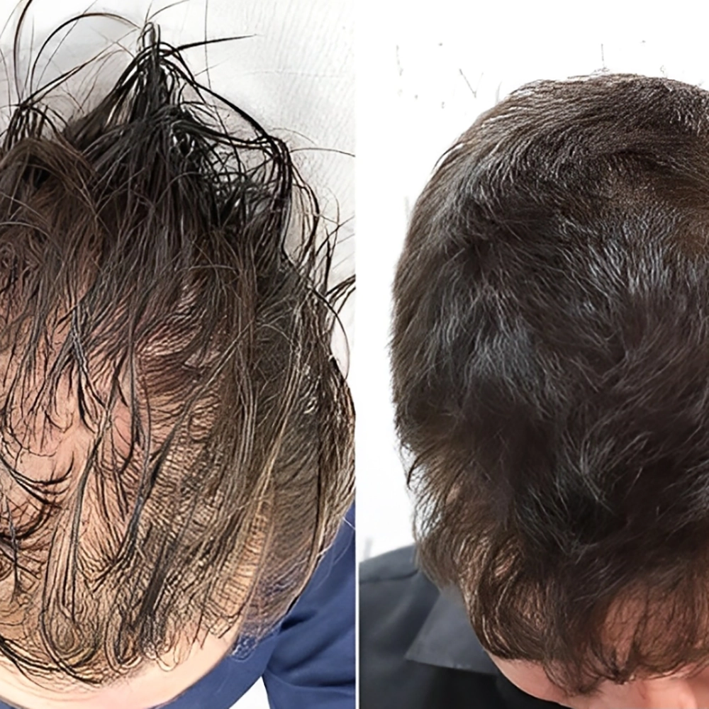 مواد تشکیل دهنده کوکتل مزوتراپی مو