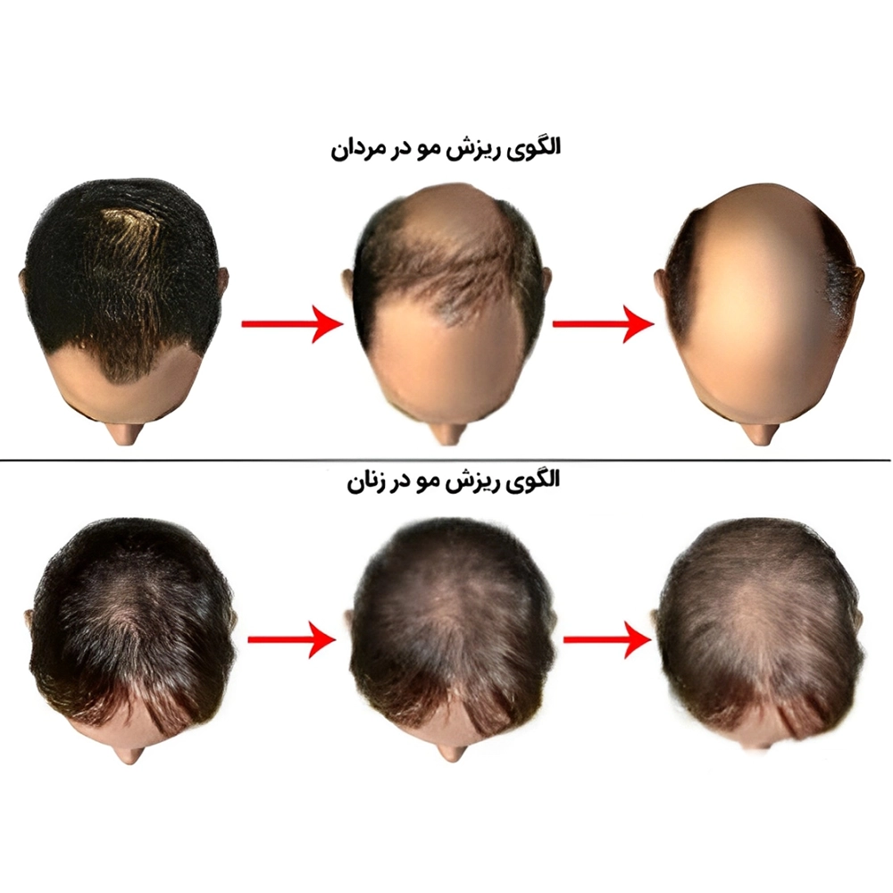 مراقبت های بعد کاشت موی سر