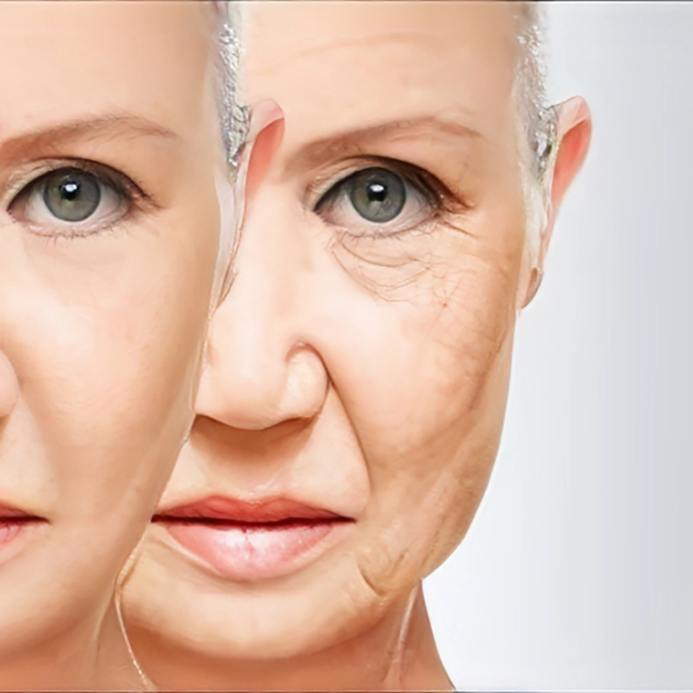 نحوه انجام تکنیک پی آر اف PRF