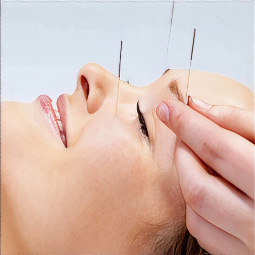 جوانسازی پوست صورت با طب سوزنی