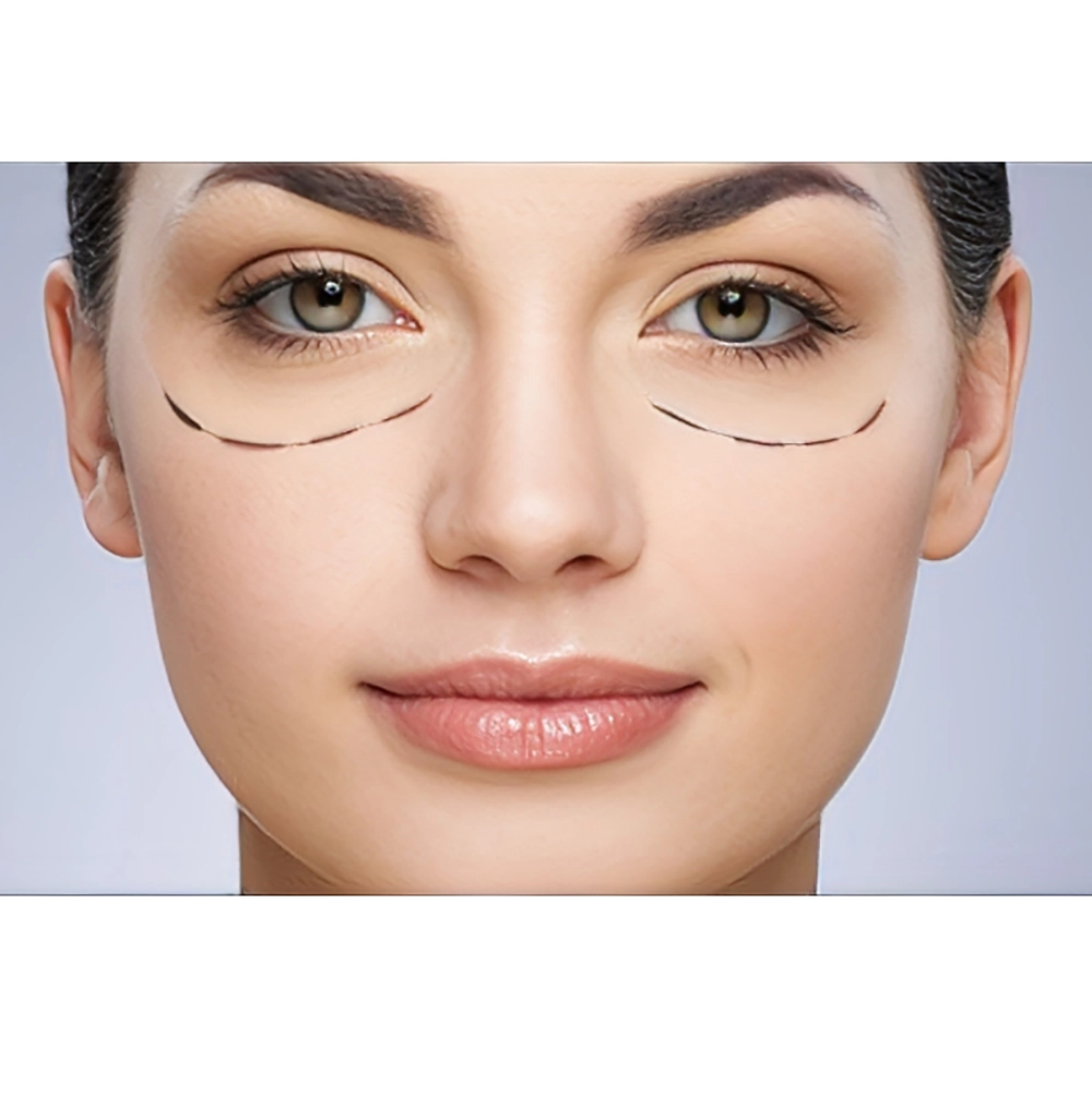 مراقبت های بعد از مزوتراپی زیر چشم