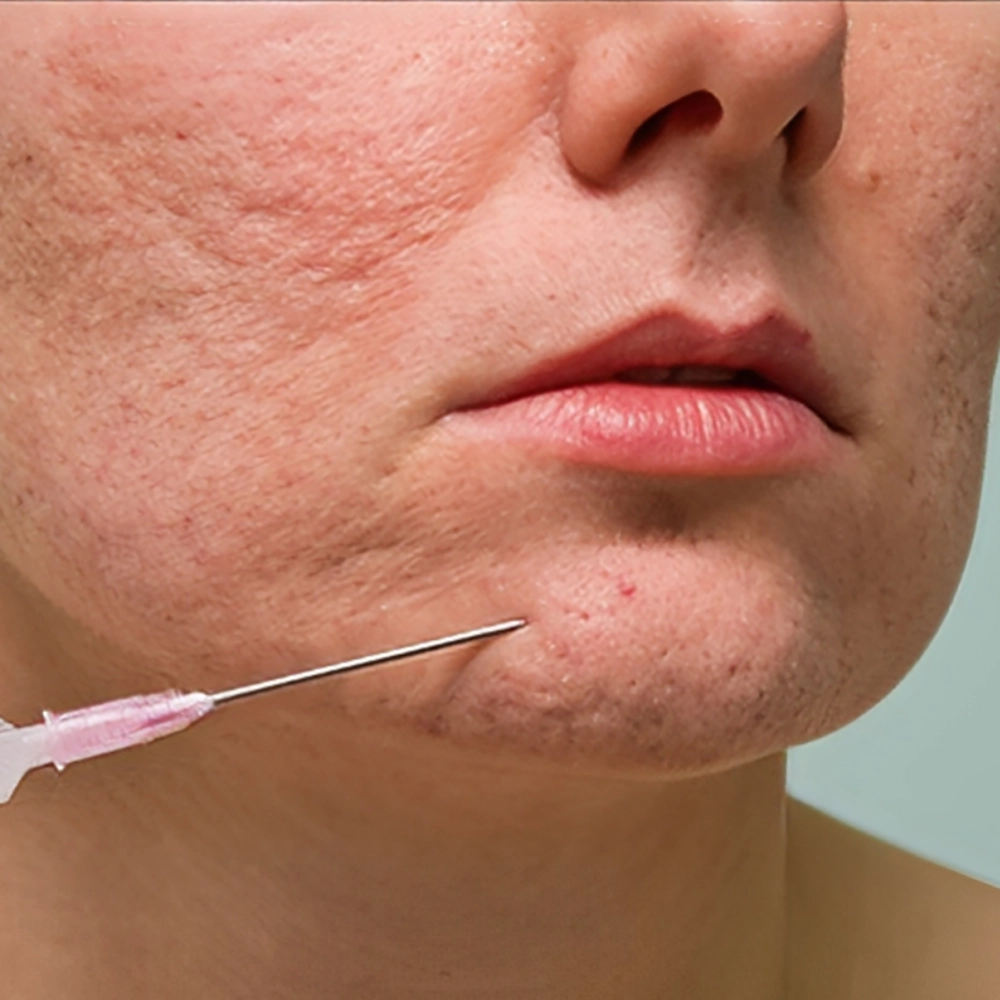 ماسک برای از بین بردن چاله های صورت