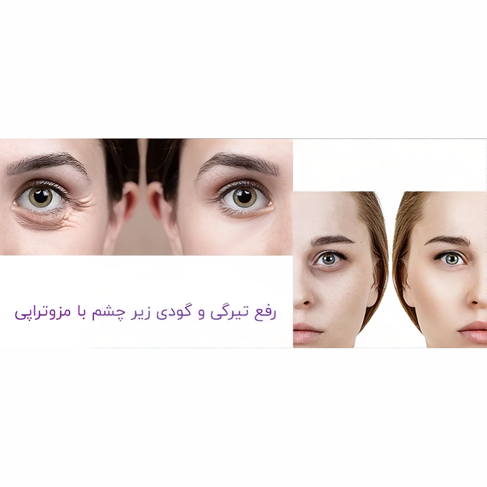 رفع گودی و تیرگی زیر چشم با مزوتراپی