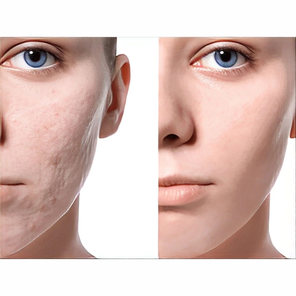 برای لک صورت لیزر بهتره یا مزوتراپی