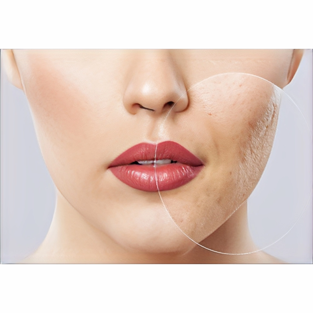 چند جلسه مزوتراپی برای لک صورت لازم است