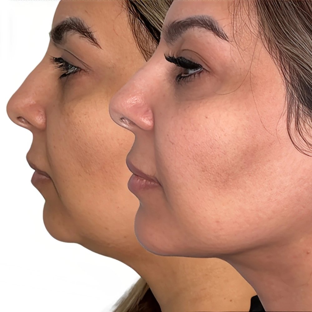 عکس قبل و بعد مزوتراپی غبغب