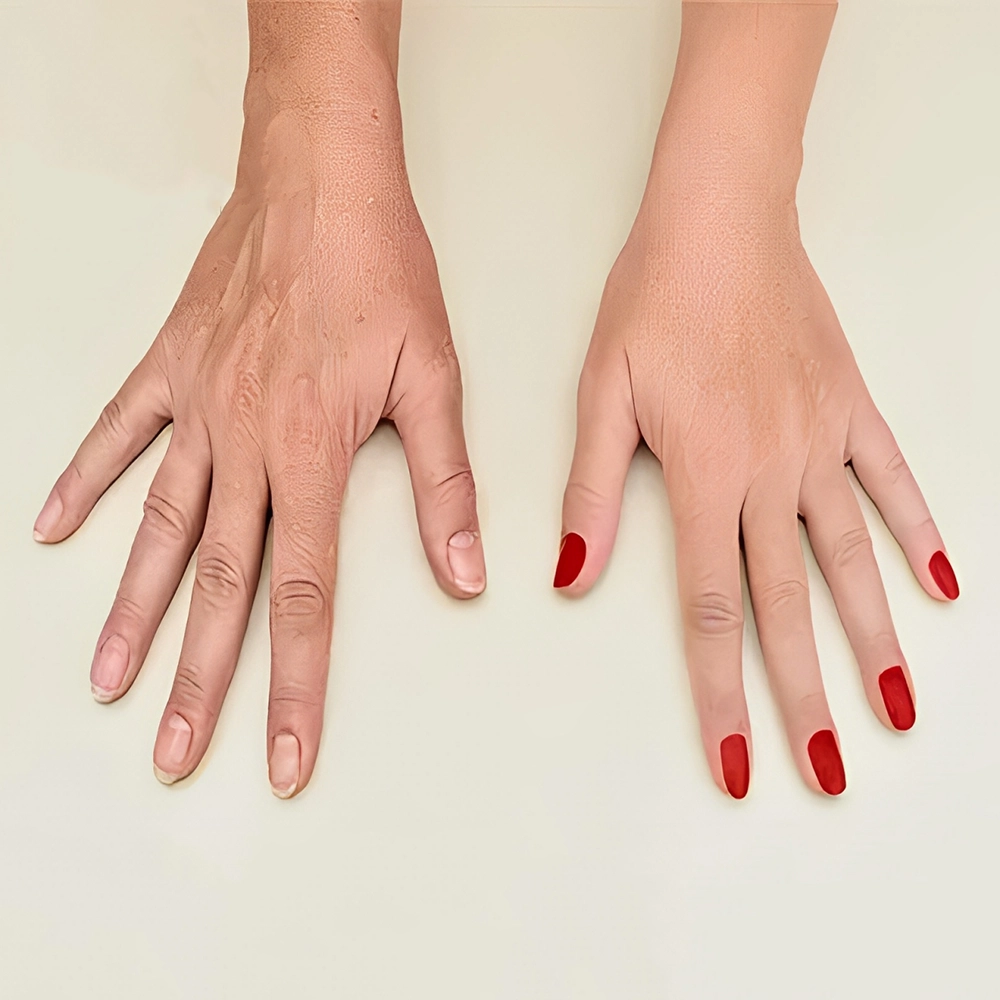 مزوتراپی دست : جوان‌ سازی و درمان لکه‌ های پیری