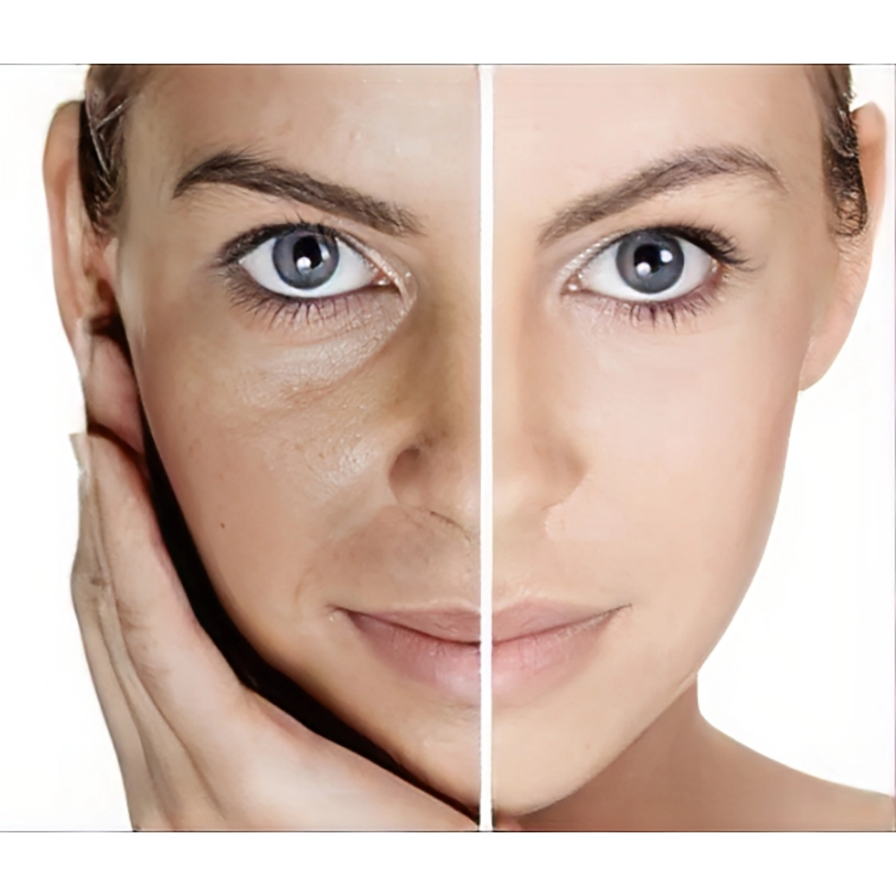 درمان ملاسما با محصولات روشن‌ کننده